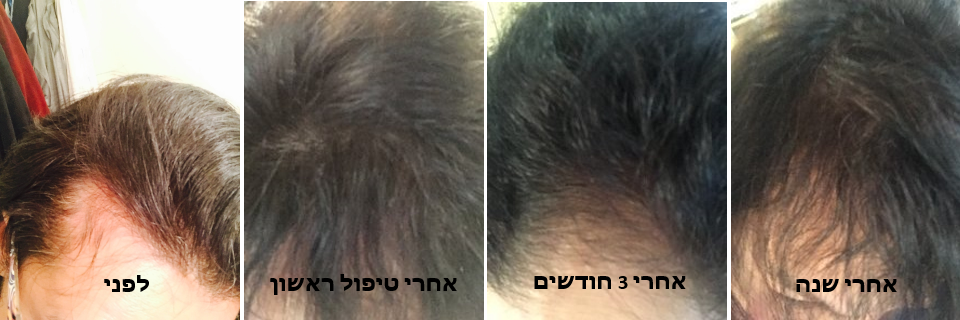 טיפולי שיער ב PRP אצל דר אלה ברוק מומחי PRP ישראל